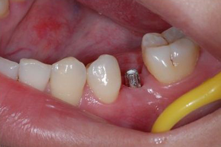 种植牙是植入植体与牙槽骨结合后,装上烤瓷牙的一种修复方式.