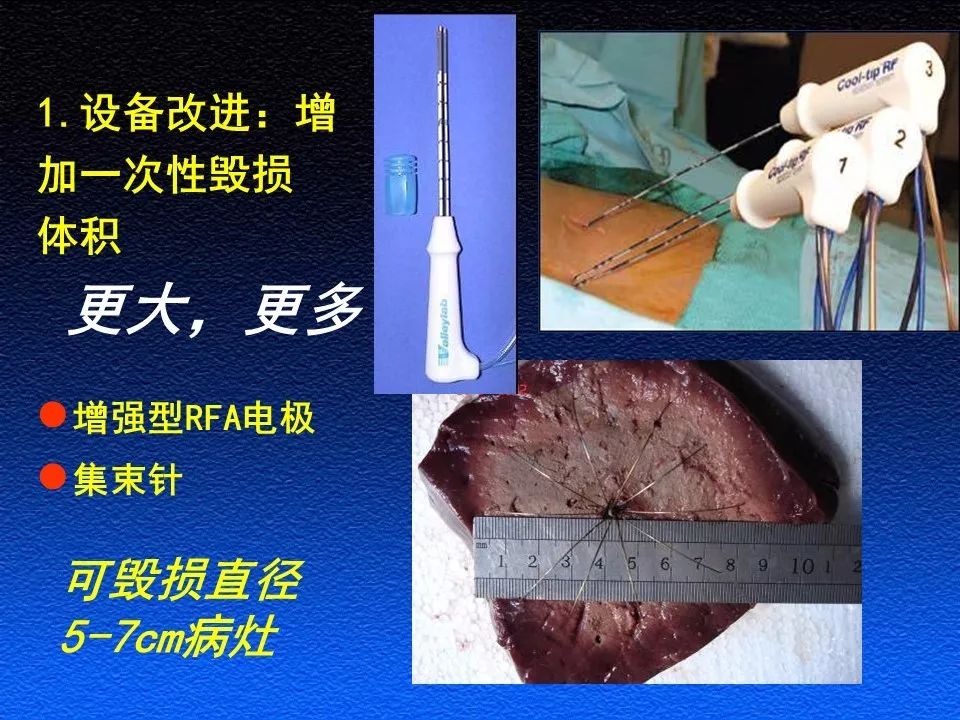 课件赏析│射频消融治疗肝肿瘤进展和探索