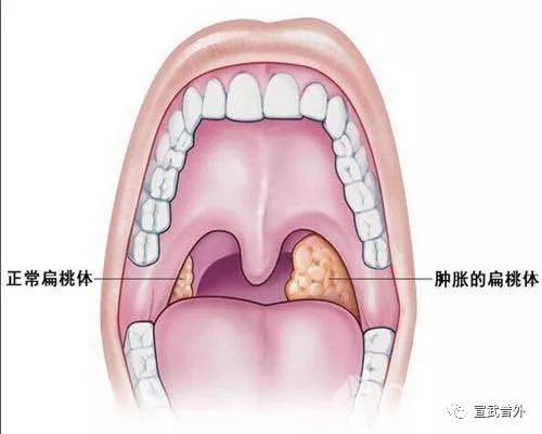 扁桃体一度肿大怎么办