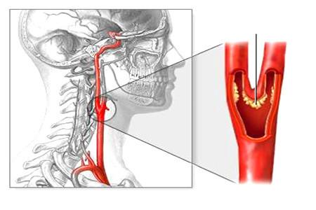 轻则头晕目眩,重则危急性命!——不可轻视的颈动脉狭窄