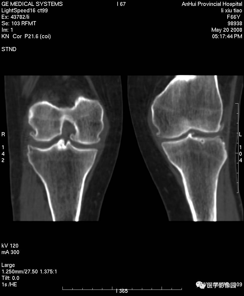 两侧胫骨髁间隆突骨质增生变尖,以右侧为明显(↑),胫骨平台关节面见囊