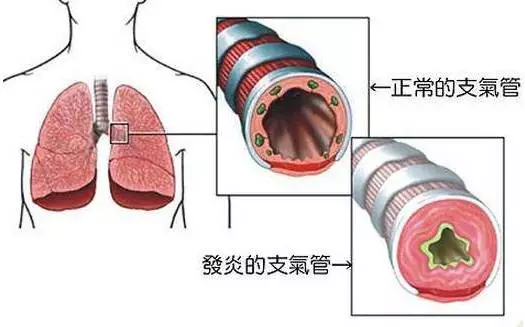 医学专家教你如何预防老年慢性支气管炎