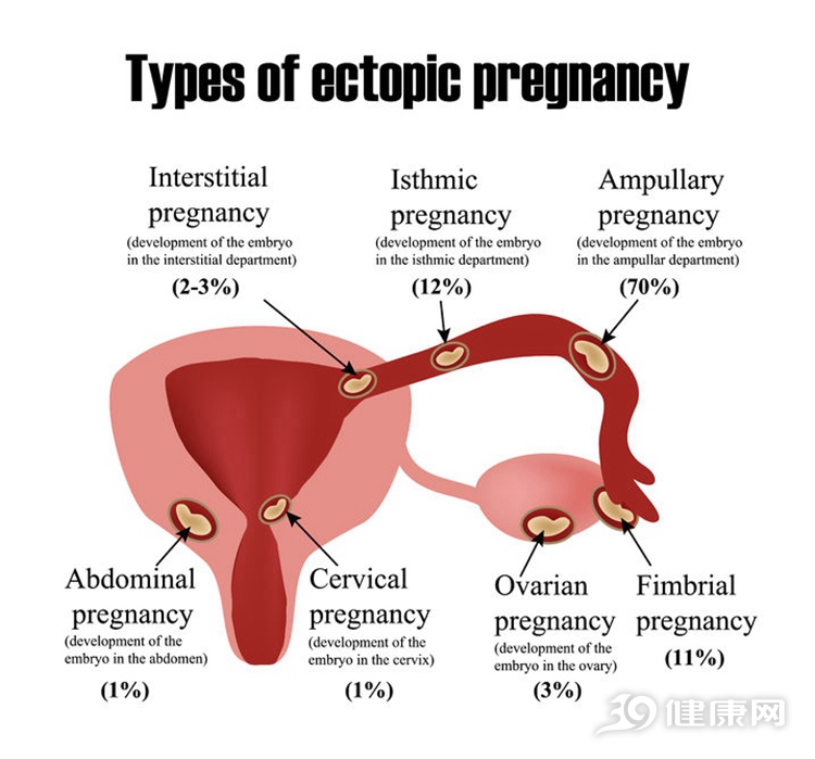 宫外孕有三个推手很多女人都一知半解