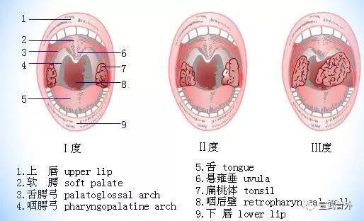 扁桃体一度肿大怎么办
