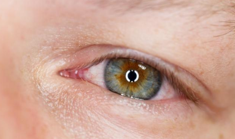 肝火最容易沿着肝经上行,当过旺的肝火到达眼睛时,会导致眼睛发炎
