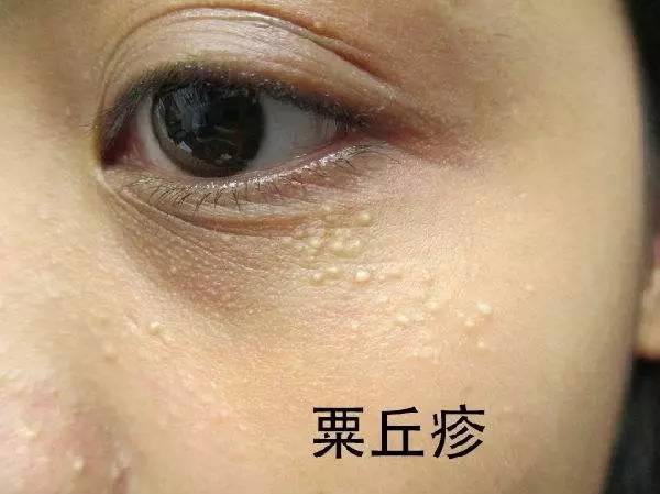 为什么喜欢长在眼部? 脂肪粒是一种长在皮肤上的白色小疙瘩,约针头般