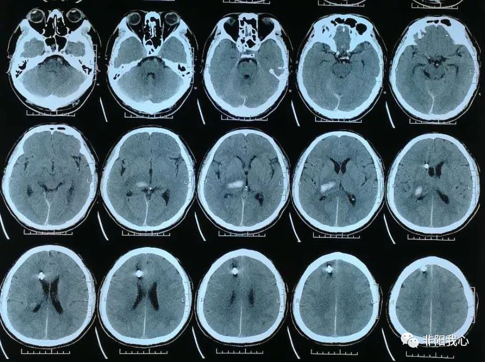 图15 复查ct显示第四脑室及中脑导水管内积血消失,脑水肿消退