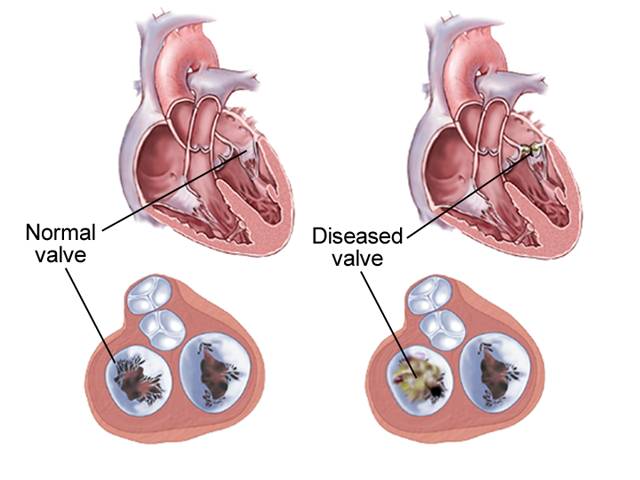 主动脉瓣疾病(aorta valve disease) 二尖瓣疾病(mitra valve