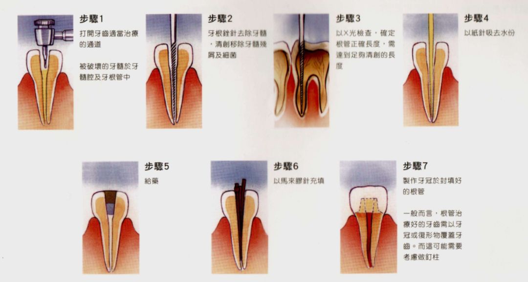 抽神经)是口腔科牙体牙髓科最为常见的一种治疗方法,当牙齿因为龋坏