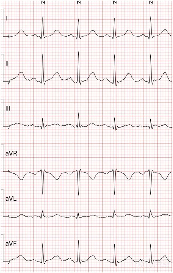 青年女性突发心力衰竭,一张心电图如何找出「真凶」?