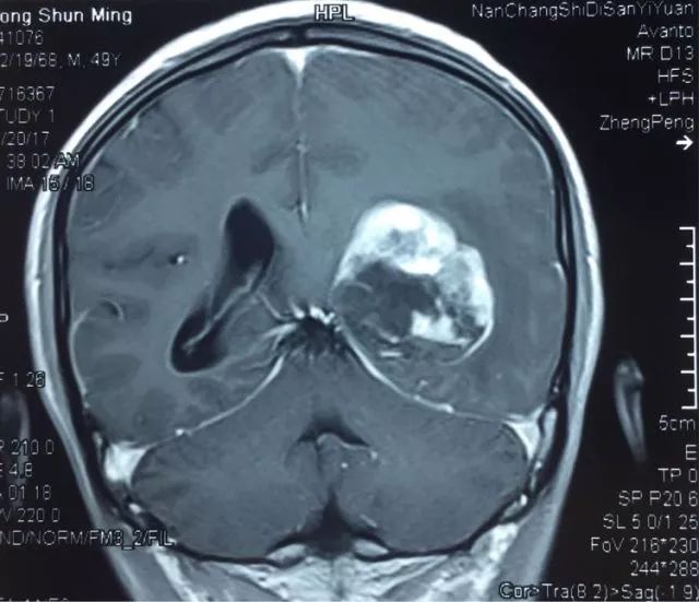 ct结果见左侧侧脑室内肿瘤合并出血