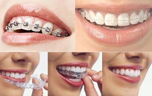 面对畸形牙患者,美奥的医生主要采取的是牙齿矫正方案,但是不少人对
