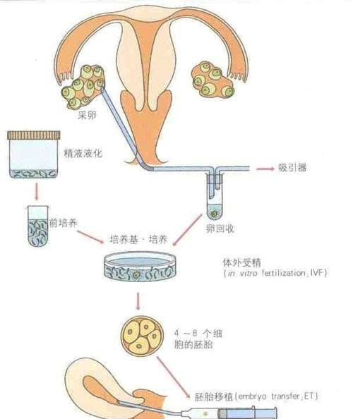 取卵子的过程,要用特殊的取卵针穿过母体的阴道穿刺取出成熟的卵泡