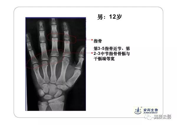 手的放置位置非常重要,因为手腕位置不对,可引起某些骨的影像与发育