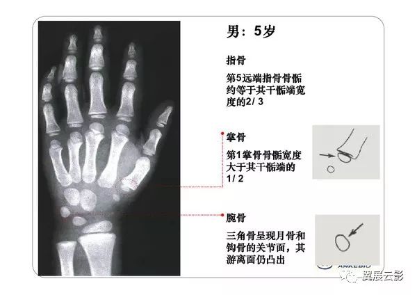 x线机的球管中心正对第三掌骨头.