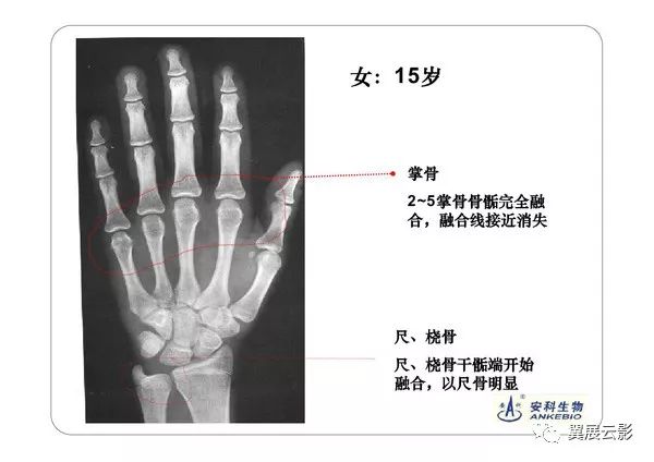 手的放置位置非常重要,因为手腕位置不对,可引起某些骨的影像与发育