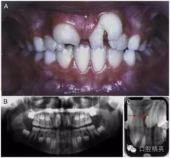 多生牙与中切牙融合病例治疗 10 年后临床效果