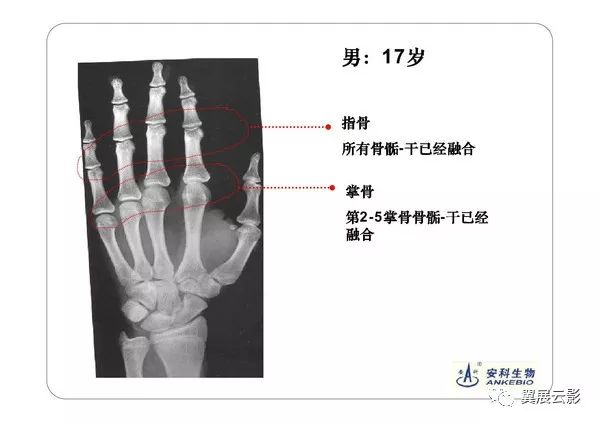 x线机的球管中心正对第三掌骨头.