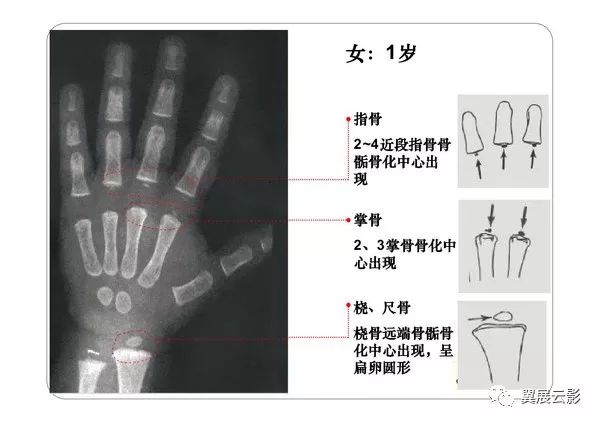 看完这篇文章,再也不怕写骨龄报告了