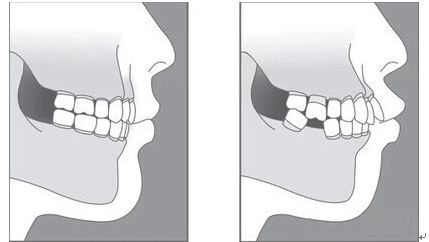 大牙掉了两颗怎么办
