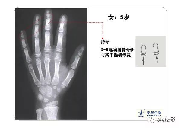 看完这篇文章,再也不怕写骨龄报告了