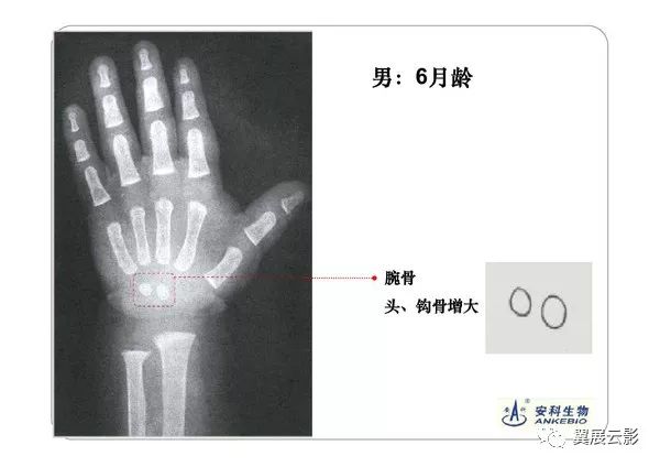 手的放置位置非常重要,因为手腕位置不对,可引起某些骨的影像与发育