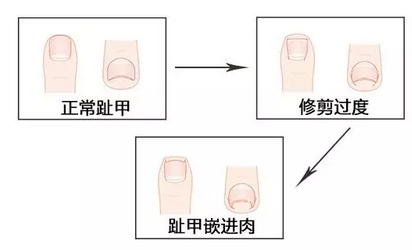 指甲一长就想剪!甲沟炎:被忽视的疾病 你真的会剪指甲