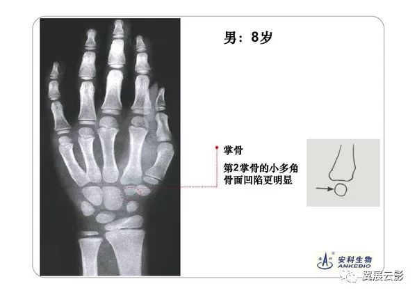 看完这篇文章,再也不怕写骨龄报告了