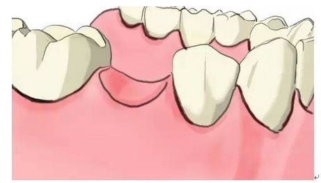 大牙掉了两颗怎么办