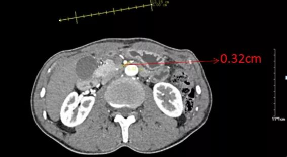 图二 腹部增强ct显示十二指肠水平段受压变窄,测量直径为0.32 cm