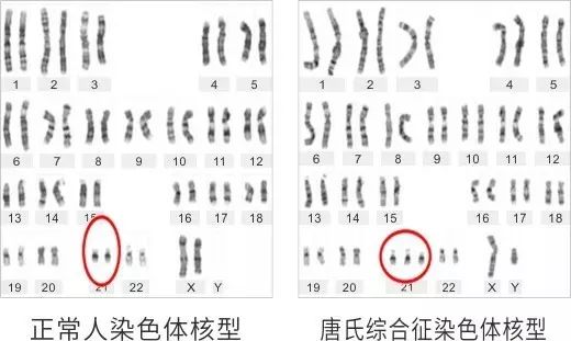 唐氏综合征是最常见的一种染色体异常,又称为21三体,在