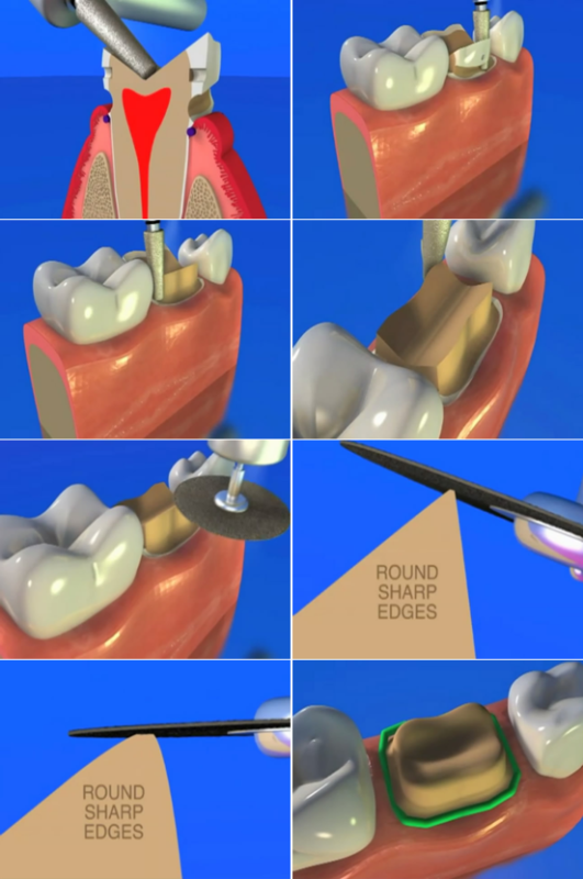 超实用-备牙标准,方法及图解