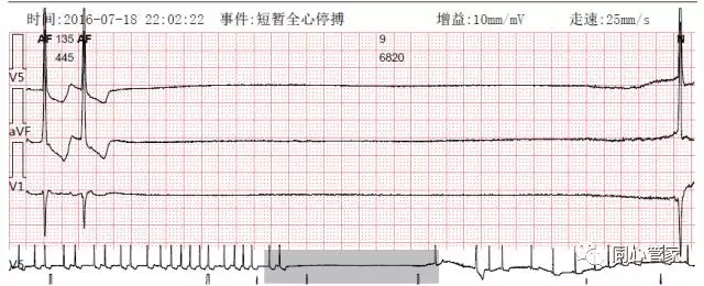 82秒的心室停搏同心课堂在日常生活中,这种一过性晕厥十分常见.