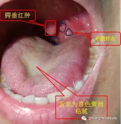 综合上述症状及舌像,诊断为急性化脓性扁桃体炎.