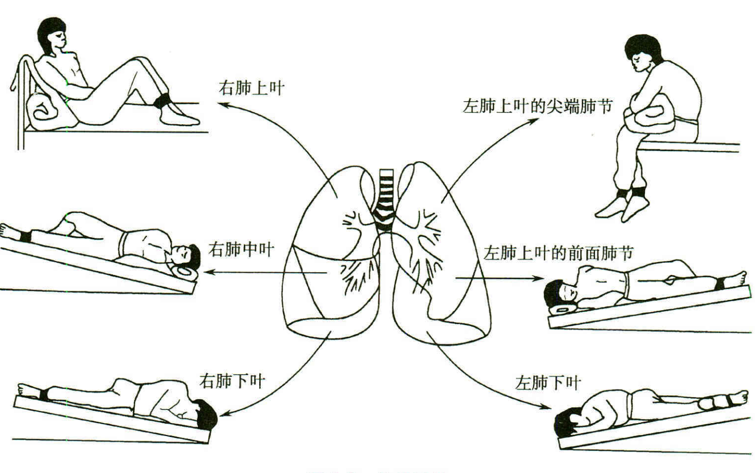 (4)胸部叩击:适用于长期卧床,久病体弱,排痰无力患者.