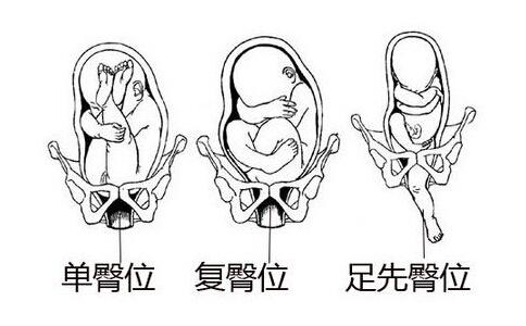 所以,当胎儿出现臀位或横位的情况时,宝妈们就不得不选择剖宫产,以最
