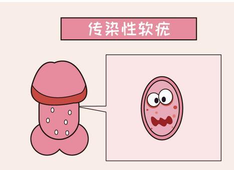 当你的身体出现这4个前兆,尤其是感冒,表示尖锐湿疣已