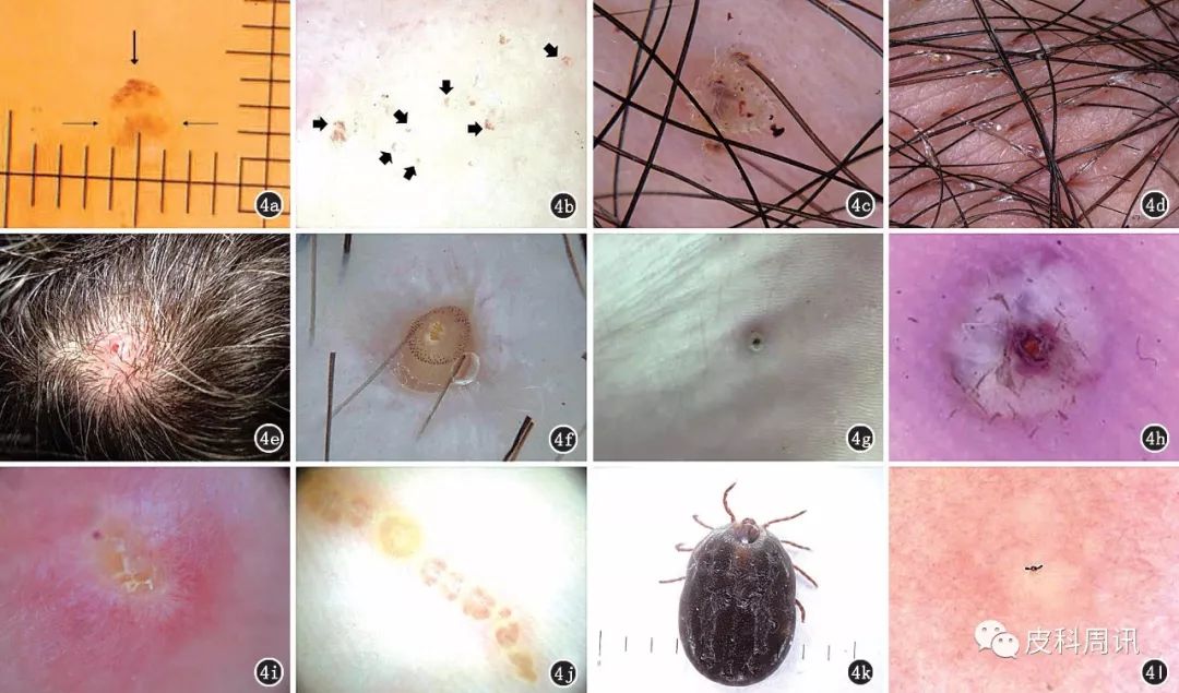 4c:阴虱的皮肤镜表现;4d:阴虱卵的皮肤镜表现;4e:皮肤蝇蛆病的临床