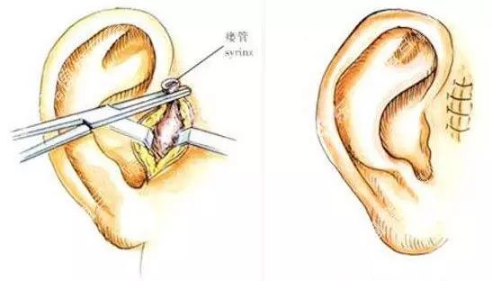 宝宝耳边上的"仓眼"被妈妈挤了后,竟然遭受了如此大的