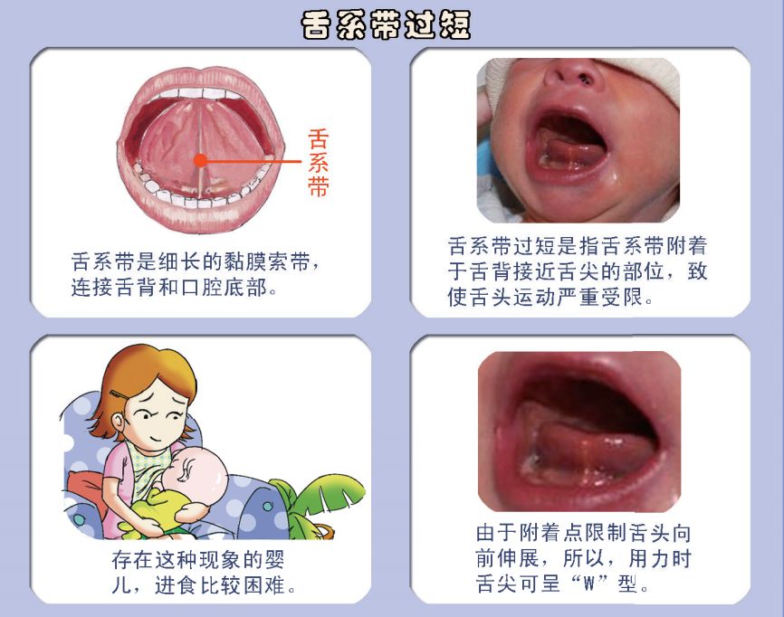 为什么有很多人带孩子做舌系带手术