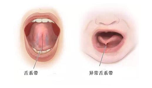 为什么有很多人带孩子做舌系带手术