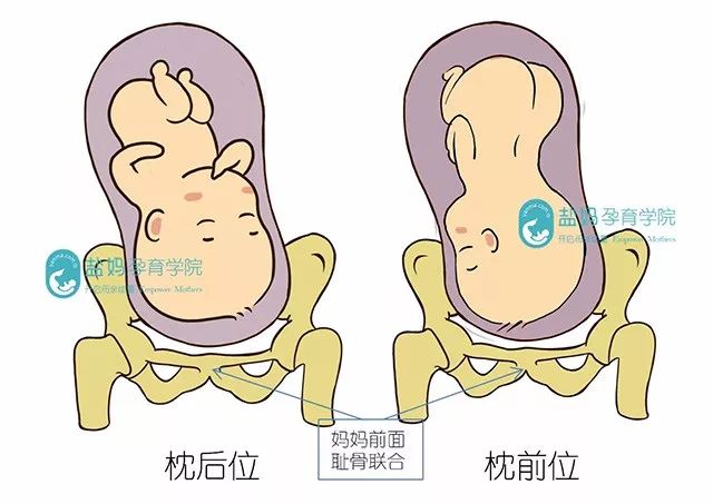 分娩挑战:枕后位是什么鬼