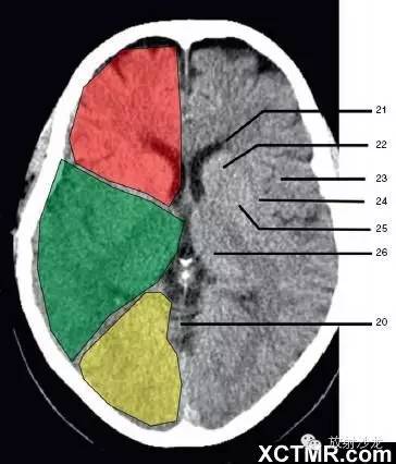 22,尾状核头部(head of caudate nucleus)