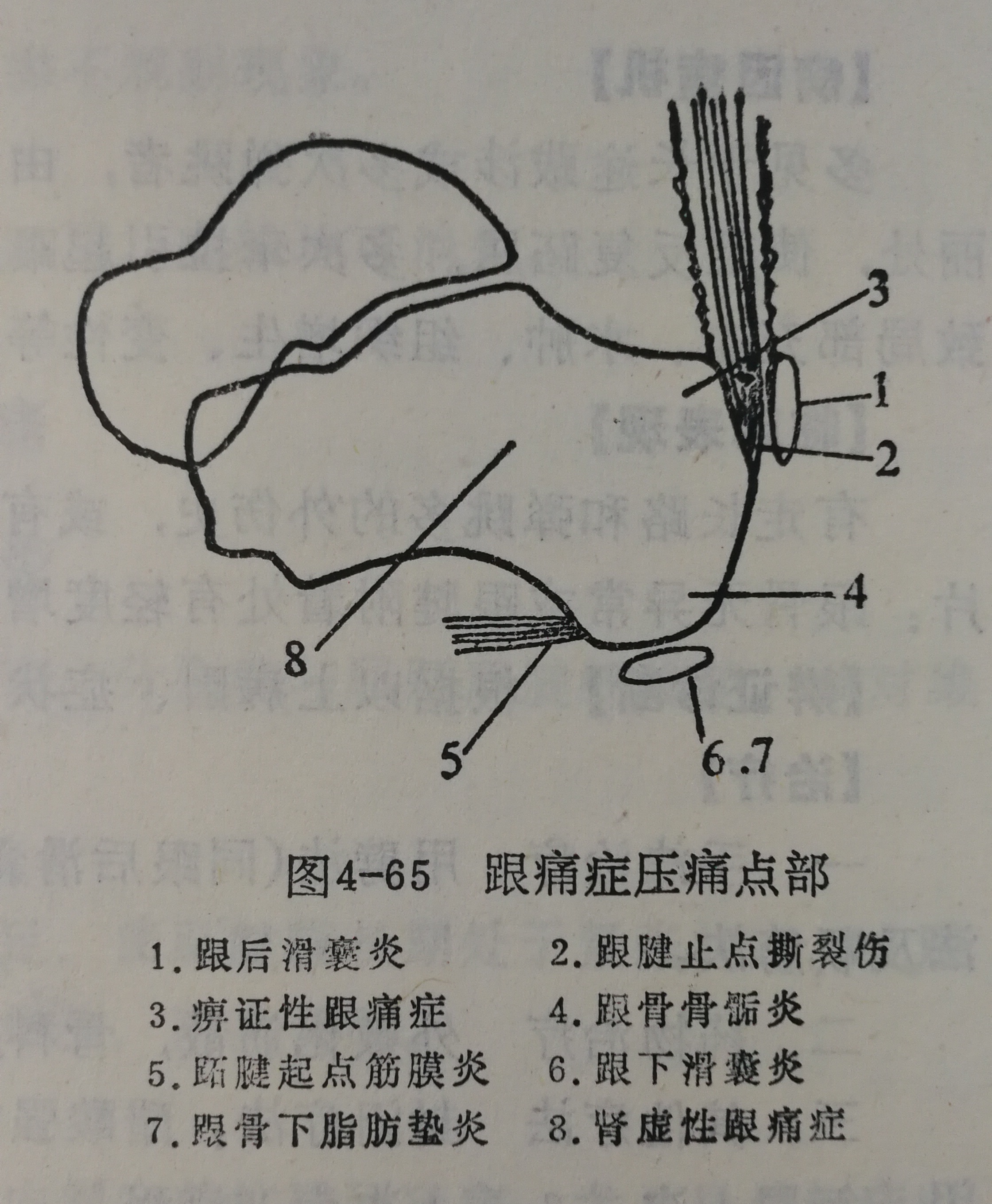 跟后痛: 主要有跟骨滑囊炎,跟腿止点