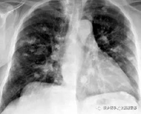 13种肺部罕见病变的影像学分析