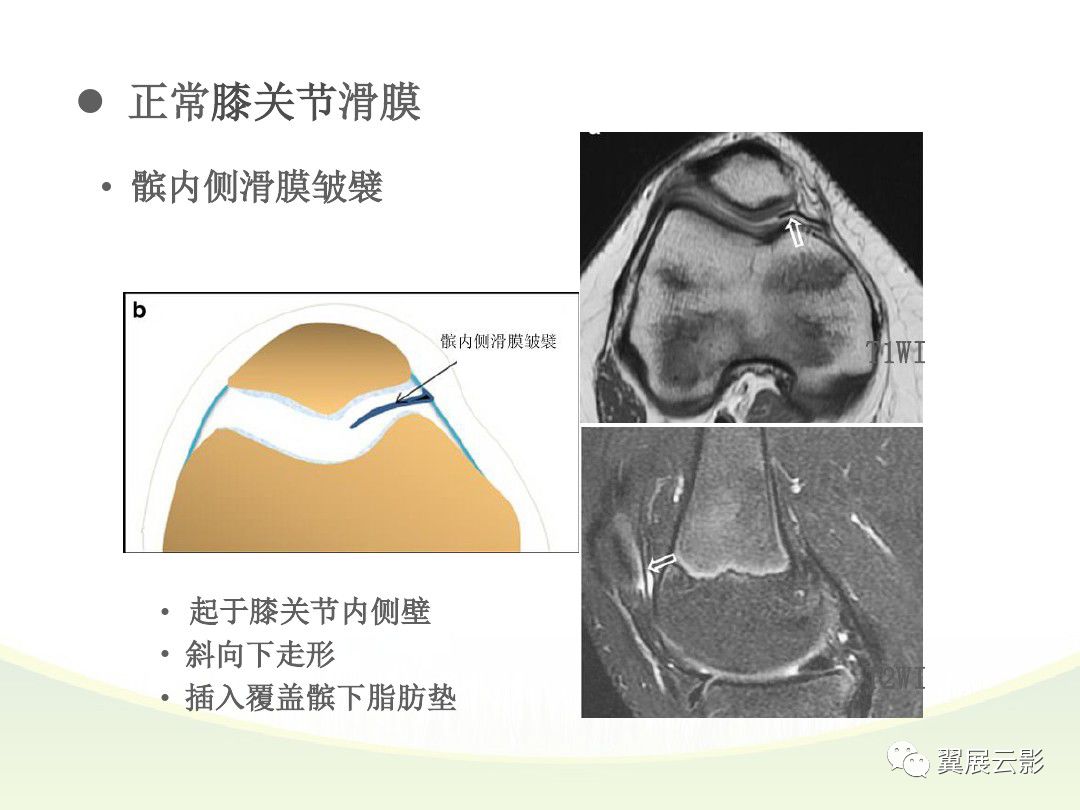 膝关节滑膜病变mri表现