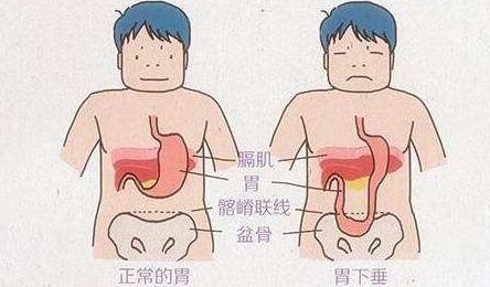 髂嵴在你做叉腰动作时放手的地方,它的位置比肚脐还要低一些.