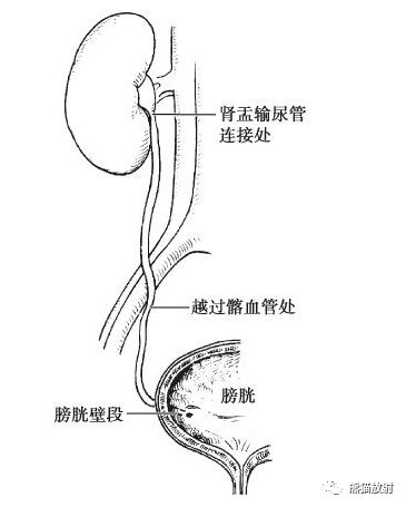 输尿管分段及狭窄