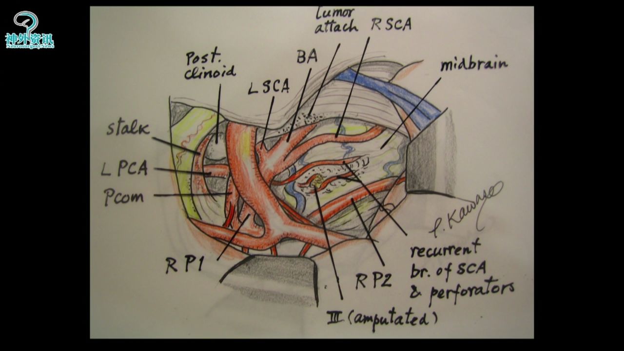 【正海-妙术视界】| kawase教授:后床突脑膜瘤的手术技巧,三角与岩前