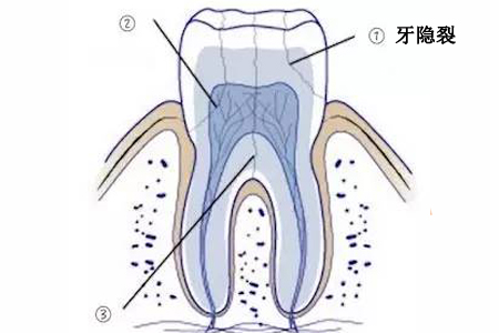 牙隐裂的原因是什么?牙医,教你3个戒律:想牙裂都难!